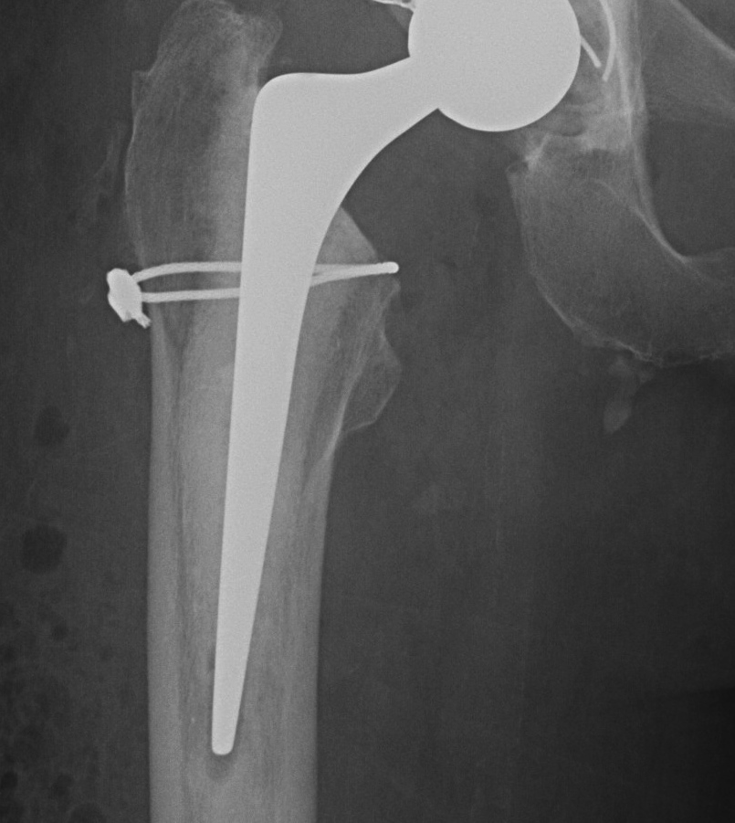 THR Femoral Intraoperative Fracture